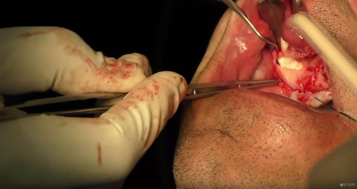 impianti dentali caduti