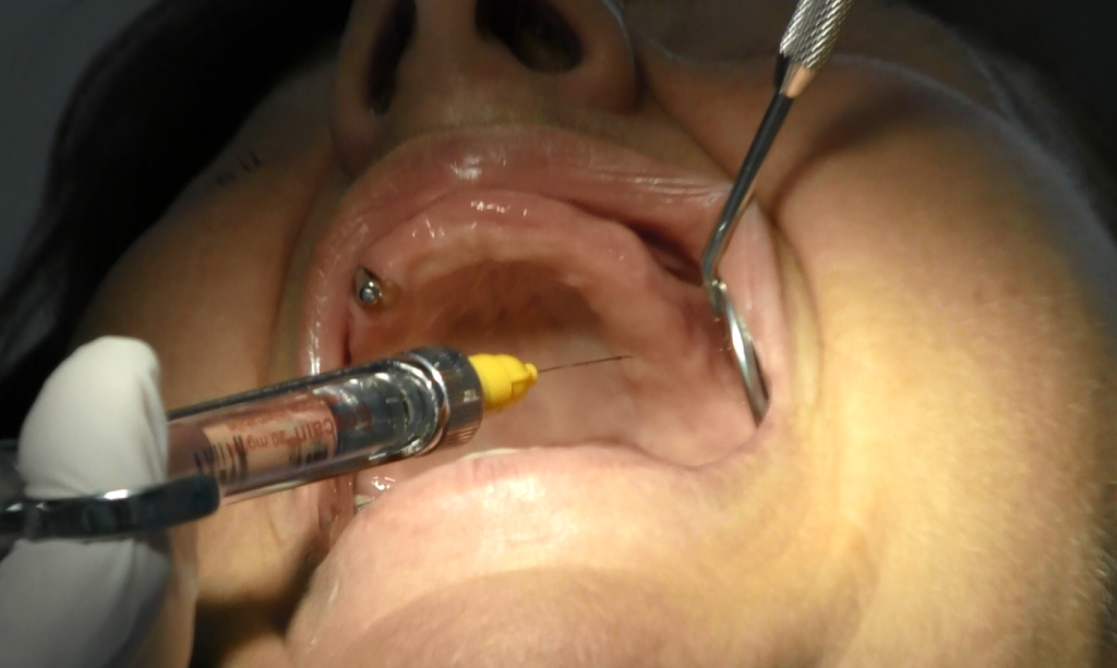 implantologia senza osso impianti dentali zigomatici