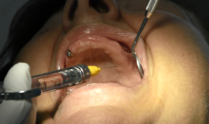 implantologia senza osso impianti dentali zigomatici