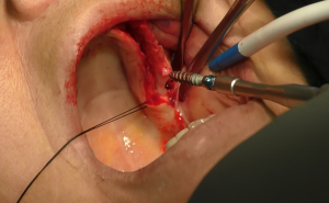 implantologia senza osso impianti dentali zigomatici