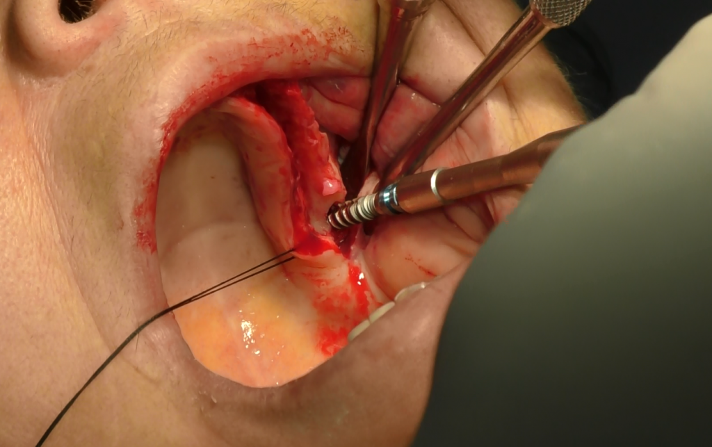 implantologia senza osso impianti dentali zigomatici