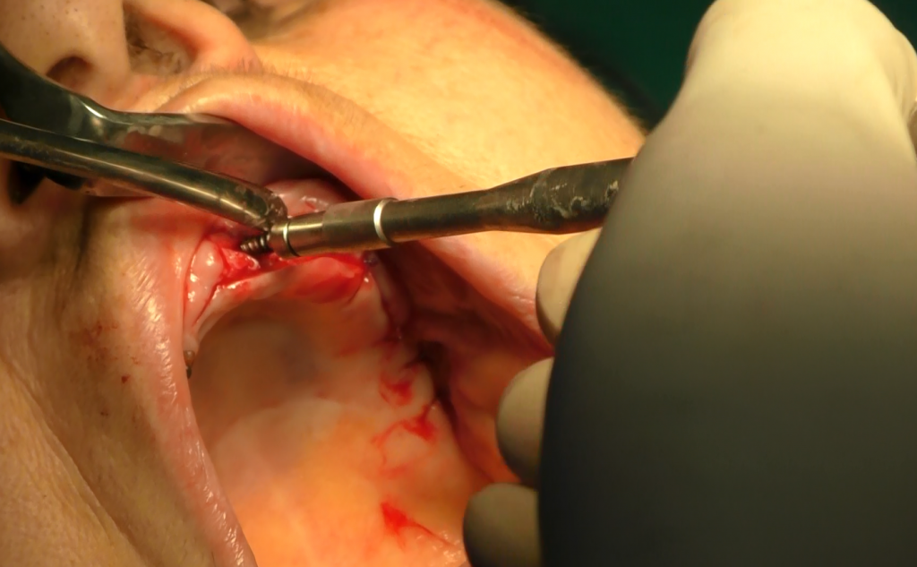 implantologia senza osso impianti dentali zigomatici
