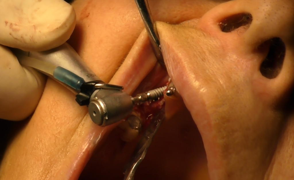 implantologia senza osso impianti dentali zigomatici
