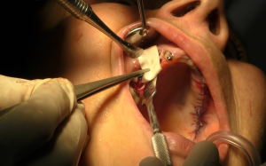 implantologia senza osso impianti dentali zigomatici
