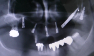 implantologia senza osso impianti dentali zigomatici