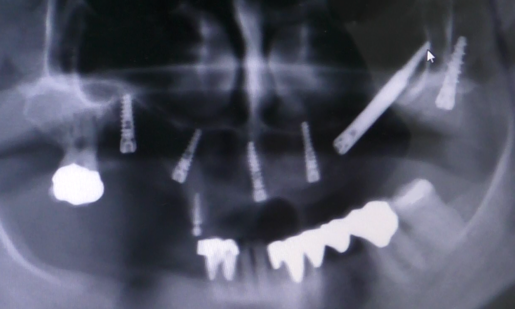 implantologia senza osso impianti dentali zigomatici