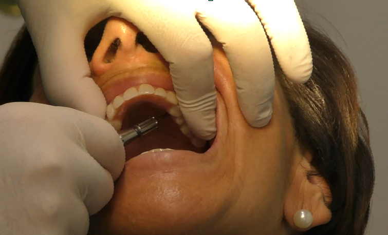 implantologia senza osso impianti dentali zigomatici