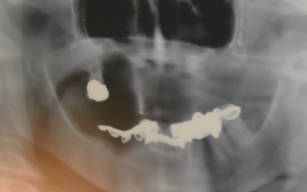 implantologia senza osso impianti dentali zigomatici